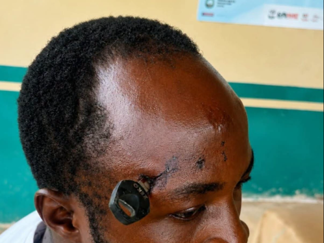 Doctors successfully remove motorbike key from farmer’s skull after Jasikan attack