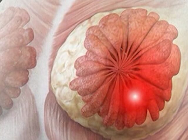 Breast cancer cases rise among younger women; experts call for early screening